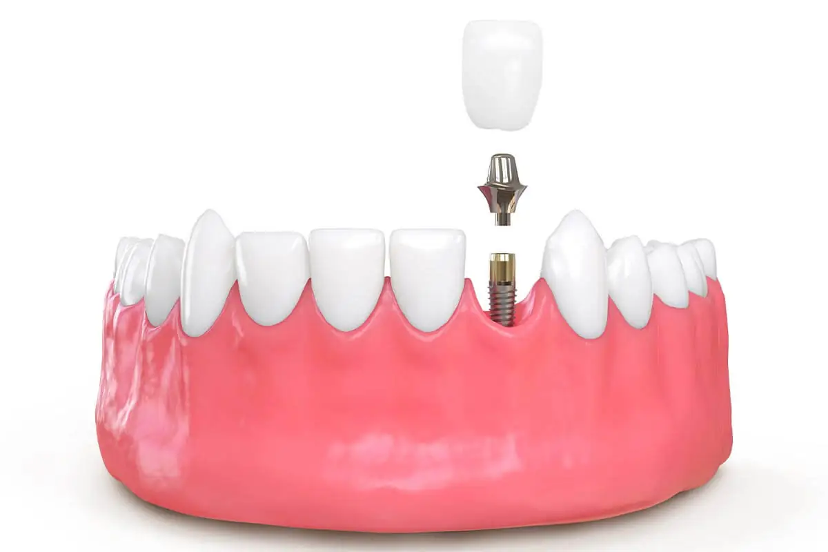 Dental Implants and Aftercare in Dallas TX Area