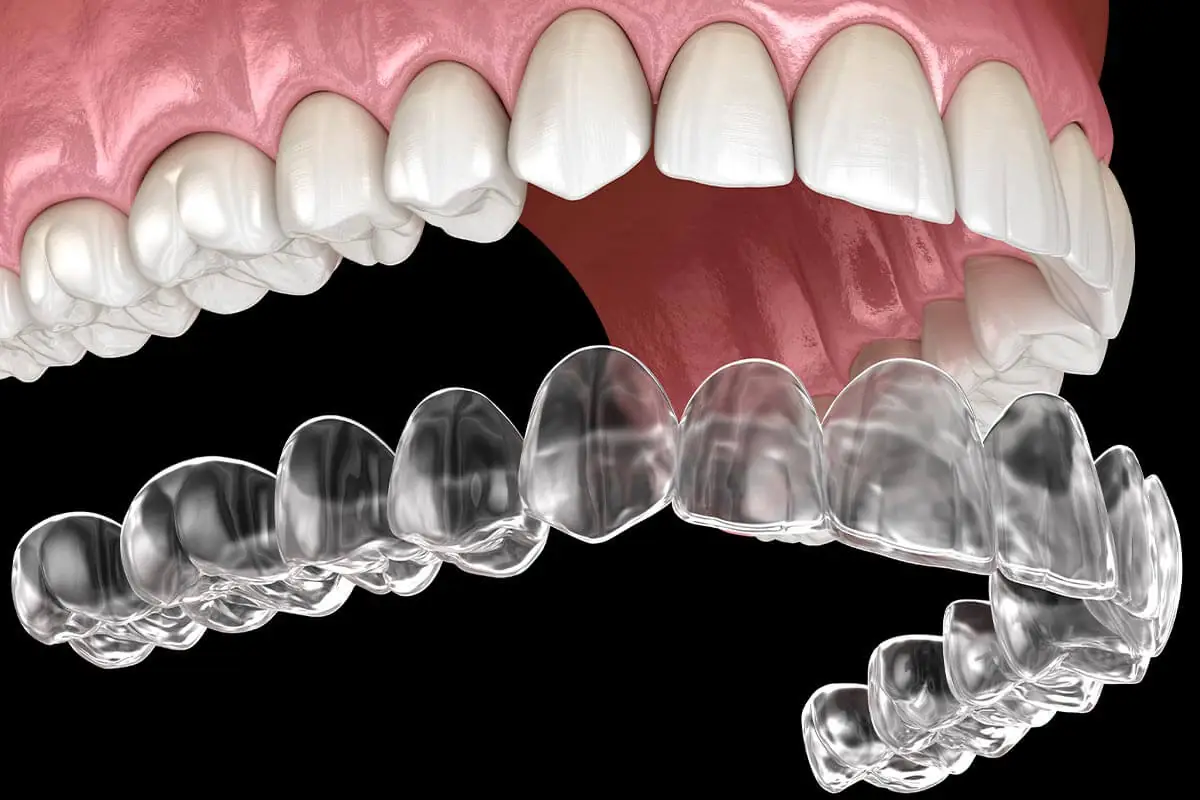 Invisible Braces Orthodontist in Dallas, TX Area