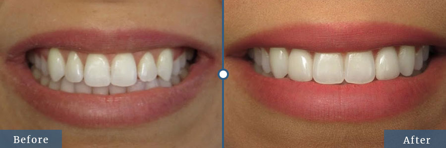 Dental veneers before after