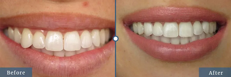 Adjusting before after