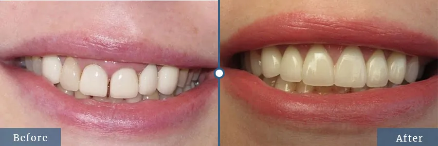 Gap before after Invisalign treatment