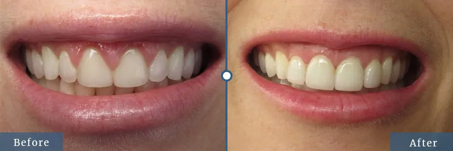 Before and After image of Veneers in Dallas TX Area