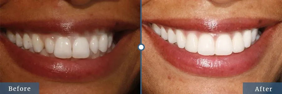 Complete smile