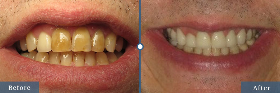 Discolored teeth before after