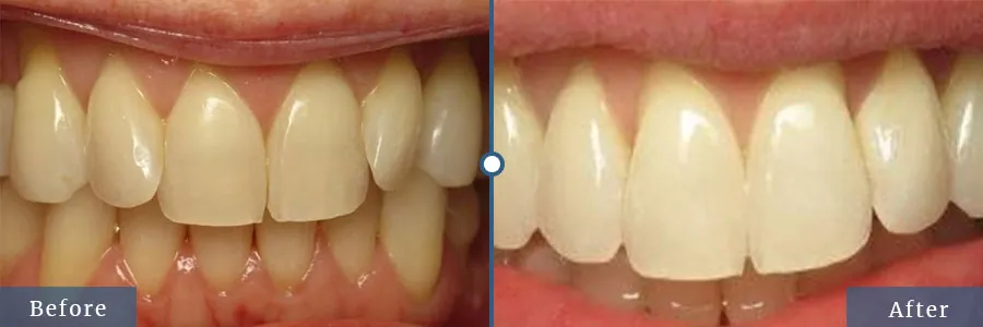 Invisalign before after