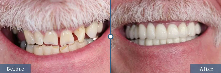 Smile makeover before after