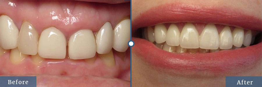 Porcelain vaneer before after