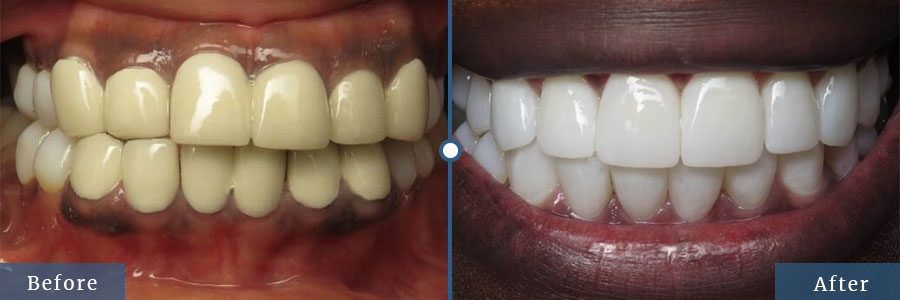 Dental Crowns Before and After patient results in Dallas TX