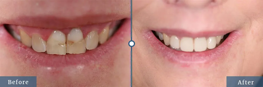 Dental Bonding before and after results Dallas TX