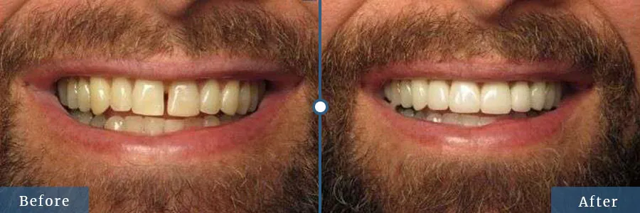 Smile make over before after