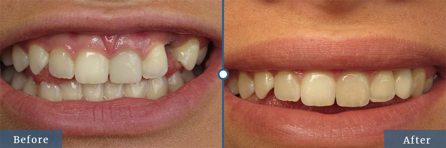 Smile makeover before after