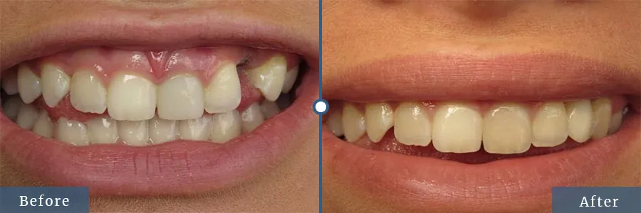 Smile makeover before after
