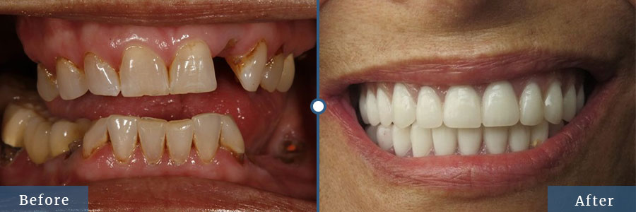 Dental Restorations best example for before and after patient done by best dentist in Dallas TX