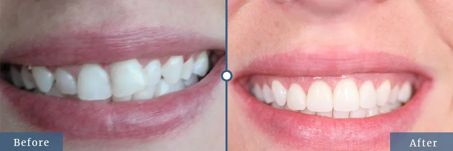 Dental Implants Before and After Patient results in Dallas TX