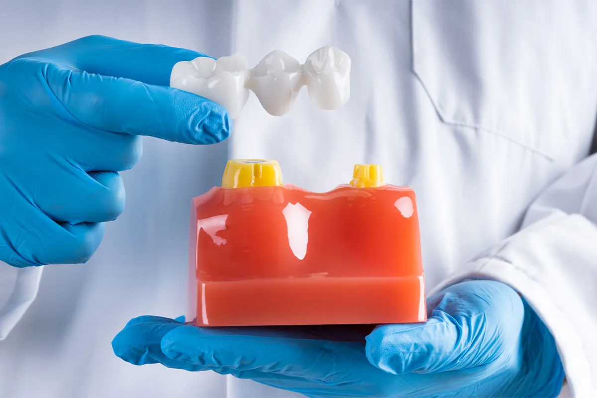 Dental bridges
