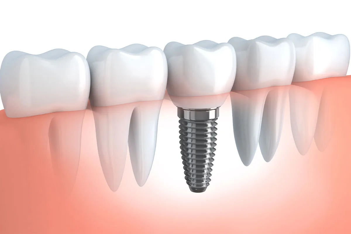 Dental implant
