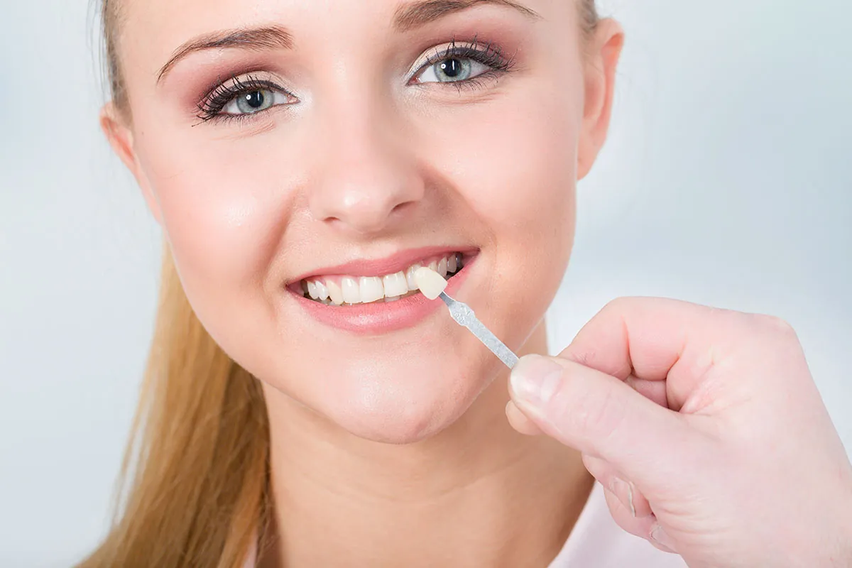 Dental veneer