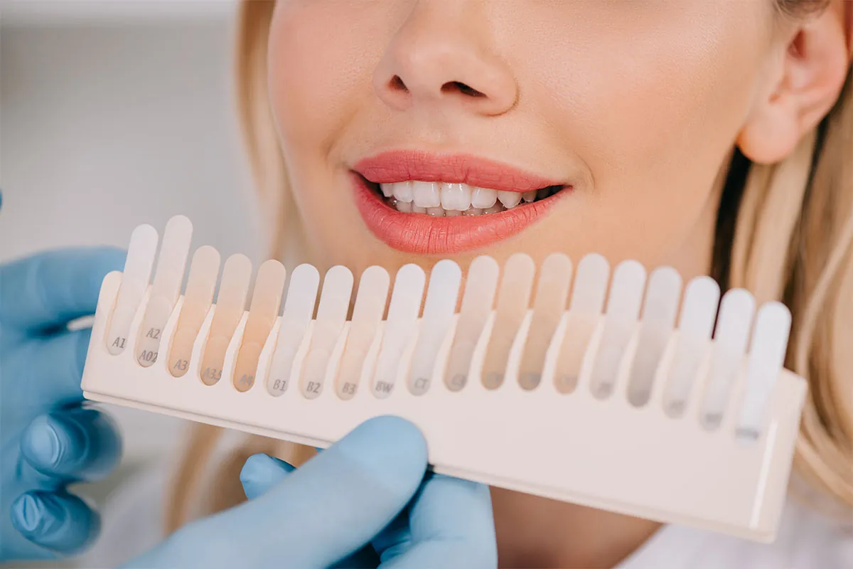 Dental veneer