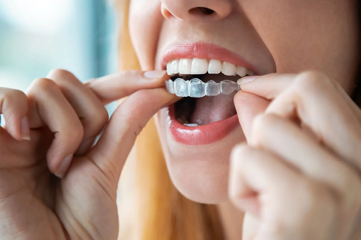 Invisalign