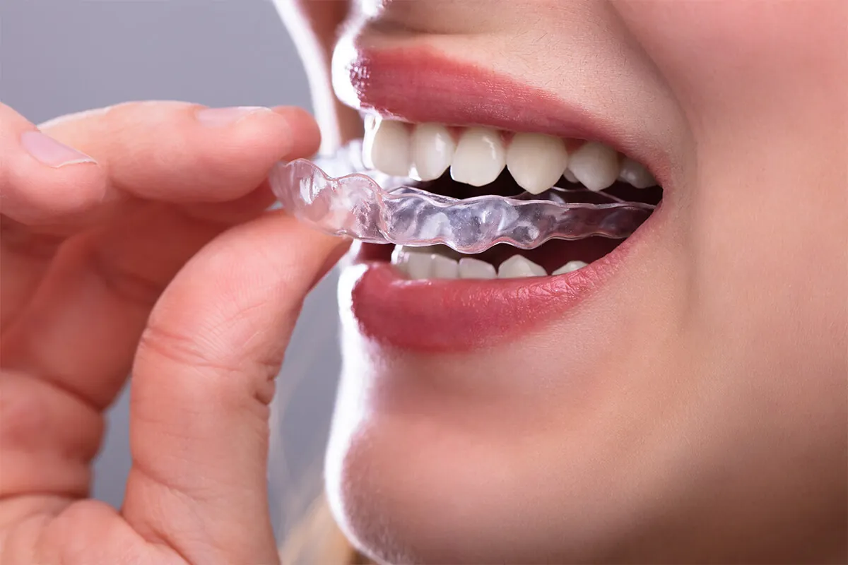Invisalign Teeth Straightening in Dallas TX Area