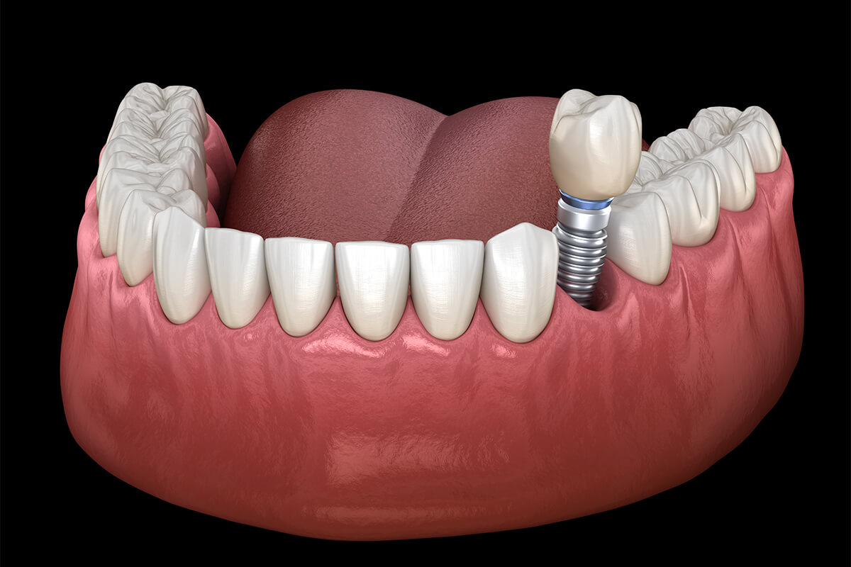 Dental Implant Aftercare in Dallas Texas Area