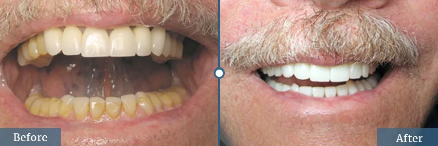 Discolored teeth with zoom whitening done by best dentist in the area