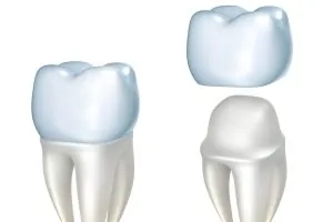 When Do I Need A Dental Crown?
