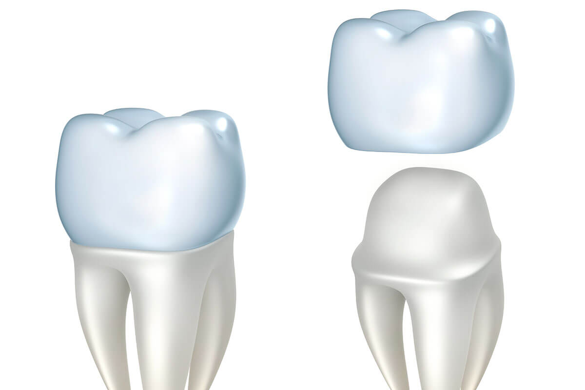 Dentist for Crown Replacement in Dallas TX Area