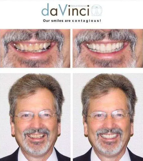 daVinci before and after results