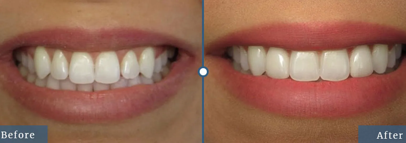 Porcelain Dental Veneers Dallas TX