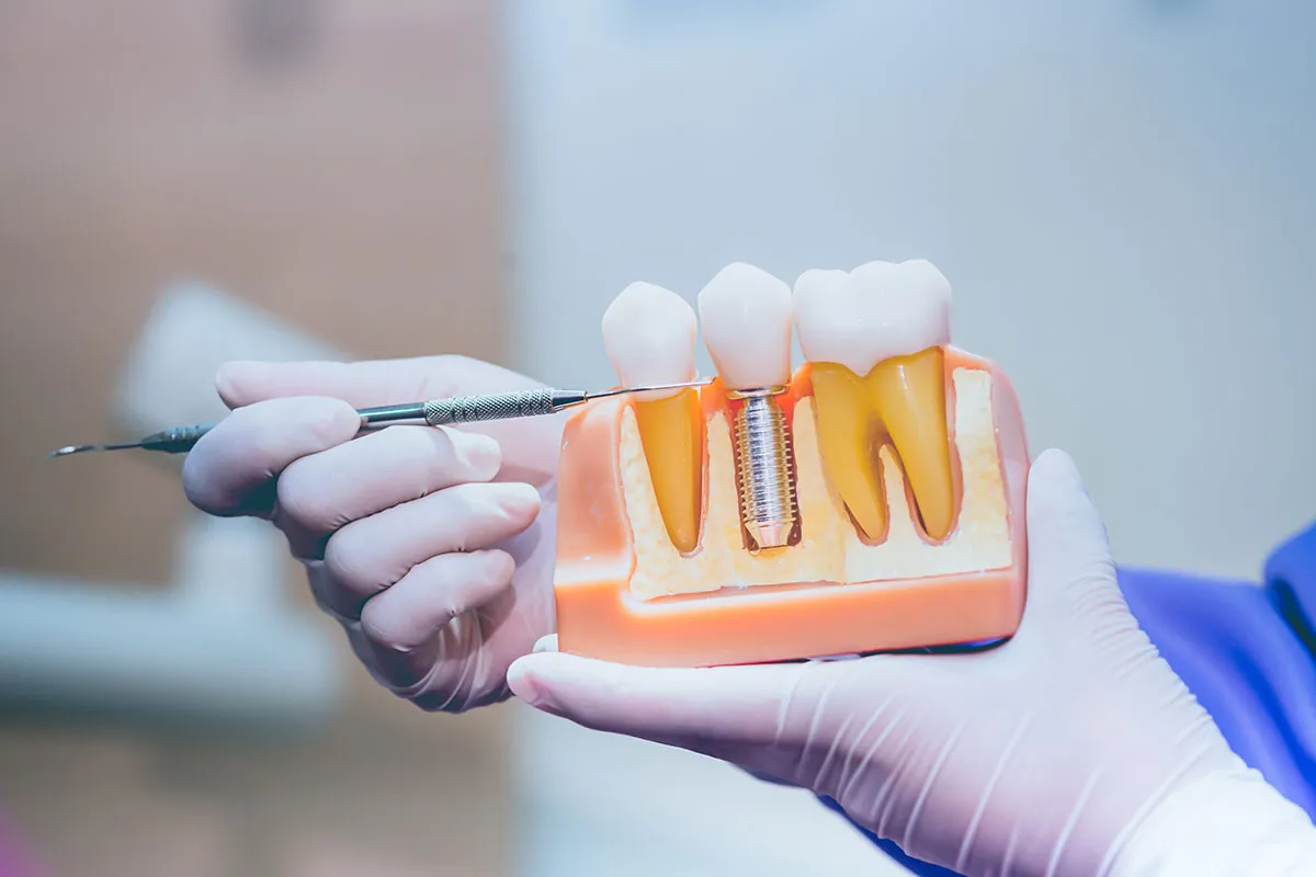 Best Dental Implant Dentist in Dallas TX Area