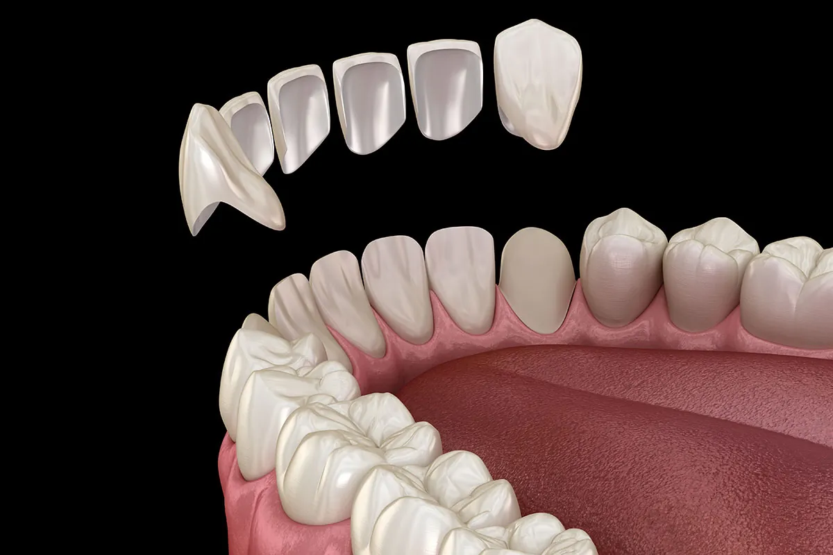 Which Veneers Look Most Natural in Dallas TX Area